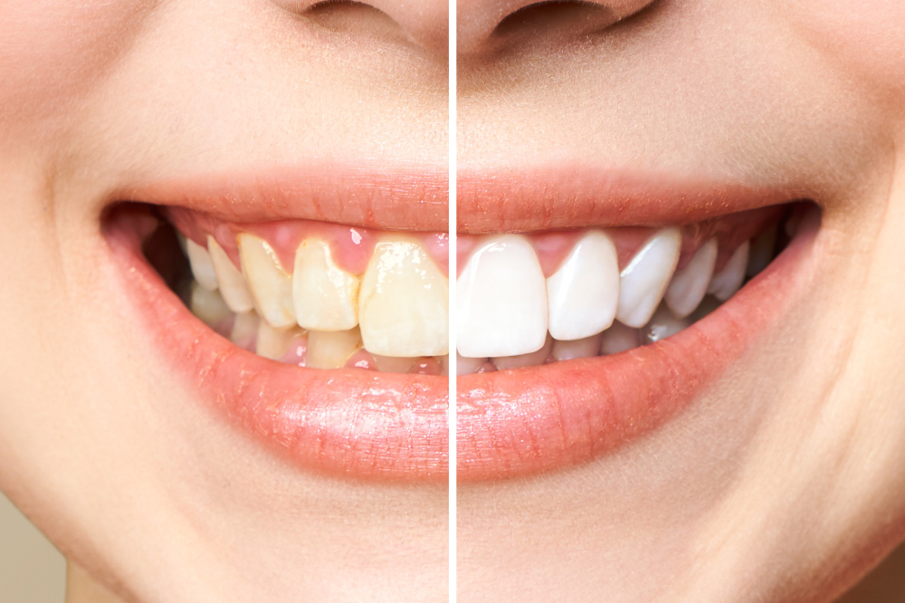 Blanqueamiento dental