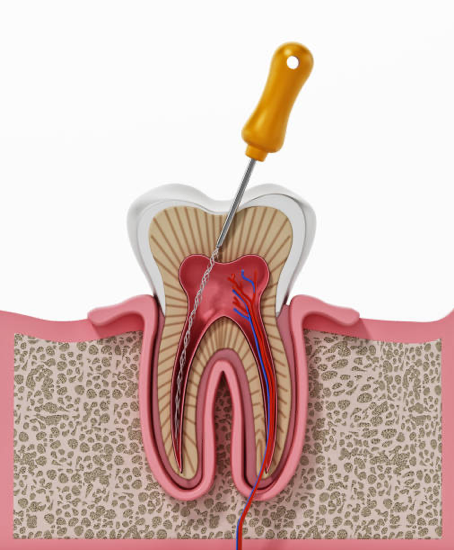 Endodoncia