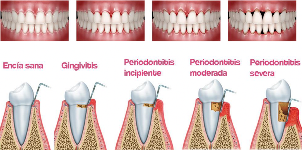 Periodoncia