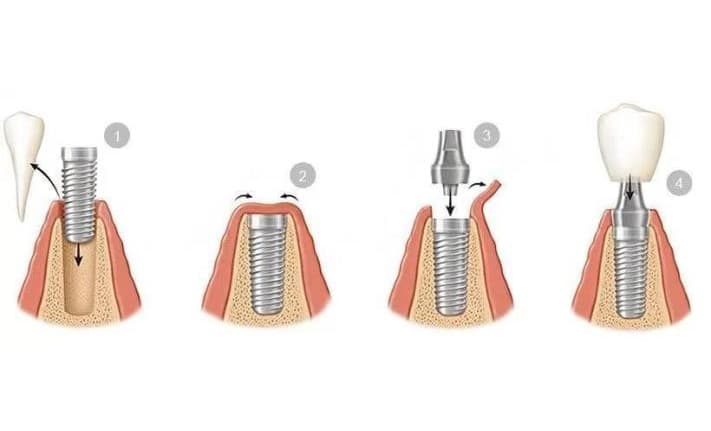 Implantes Dentales