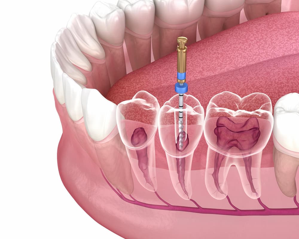 Endodoncia